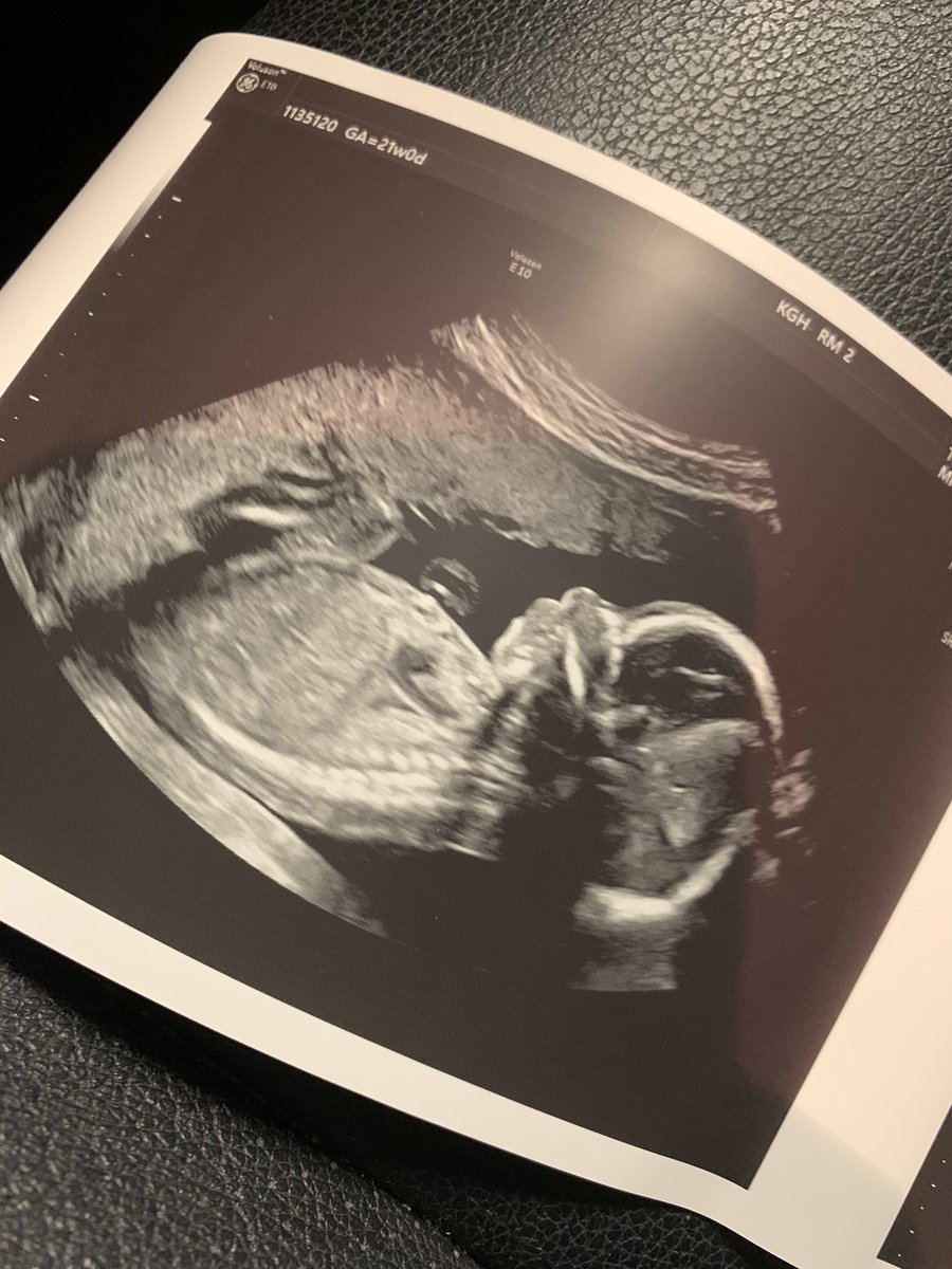 DiannaahE's tweet image. 21 weeks today! Anatomy scan today! A precious looking 3D Scan of mamas baby boy Caysen 😍❤️ today is a great day 🙈 #babyboythree #boymamaforlife #anatomyscan