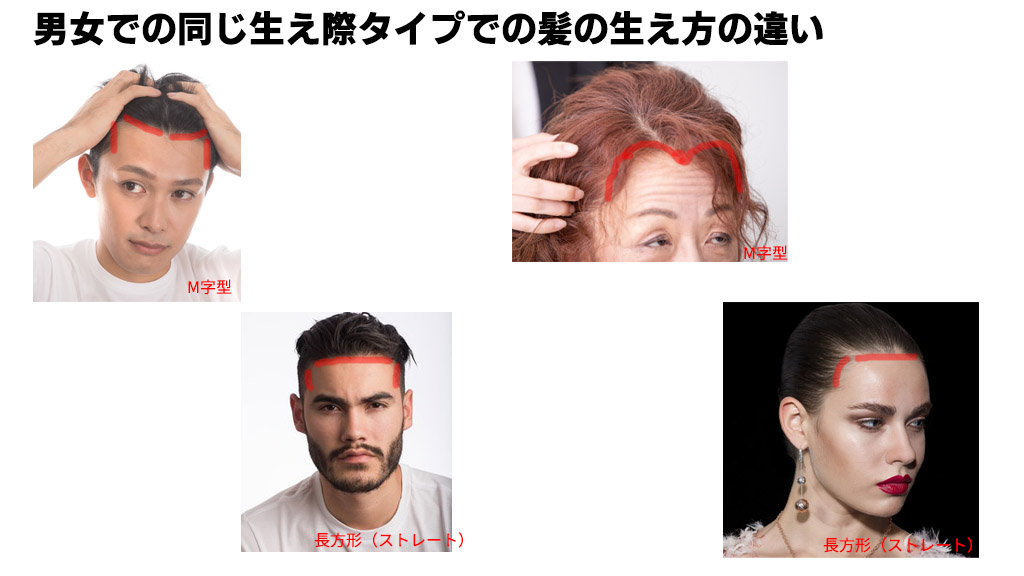 なお Onaco おでこの男女差 はるな愛さんは富士額をメイクで書きおでこを女性らしくした と聞くと形に固執しがちだが女性でもm字や四角形のタイプもあるので直線的か曲線的かの方が大事 m字 直線的で大文字のm 小文字のmに近い 長方形 ロ なお Onaco おでこの男女差 はるな愛さんは富士額をメイクで書きおでこを女性らしくした と聞くと形に固執しがちだが女性でもm字や四角形のタイプもあるので直線的か曲線的かの方が大事 m字 直線的で大文字のm 小文字のmに近い 長方形 ロ