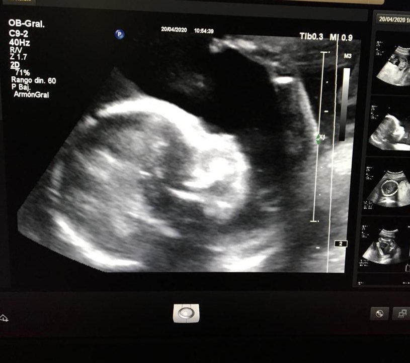 #infertilpandy Eco de la semana 20 superada! Os presento a mi niña ☺️ estamos muy contentos, viviendo un sueño, ojalá pronto todas estéis en mi misma situación. La placenta baja, eso si, tengo que hacer seguimiento en 6 semanas a ver si sube 🙏. Un abrazo,fuerza y animo a todas💙