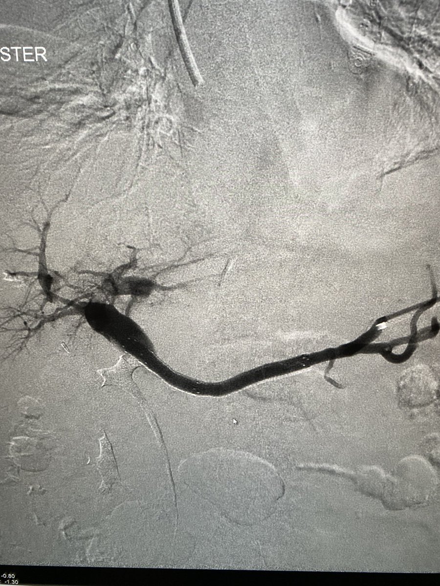 Hey can we get this lady out of hospital? Diffuse gastropathy and oozing blood. S/p nanoknife from 2 years ago with portal occlusion. My flippant answer- only way is a portal recon.  Their response-Let’s do that.
Transhep + transplenic + powerwire + viabahn= discharge after 48hr