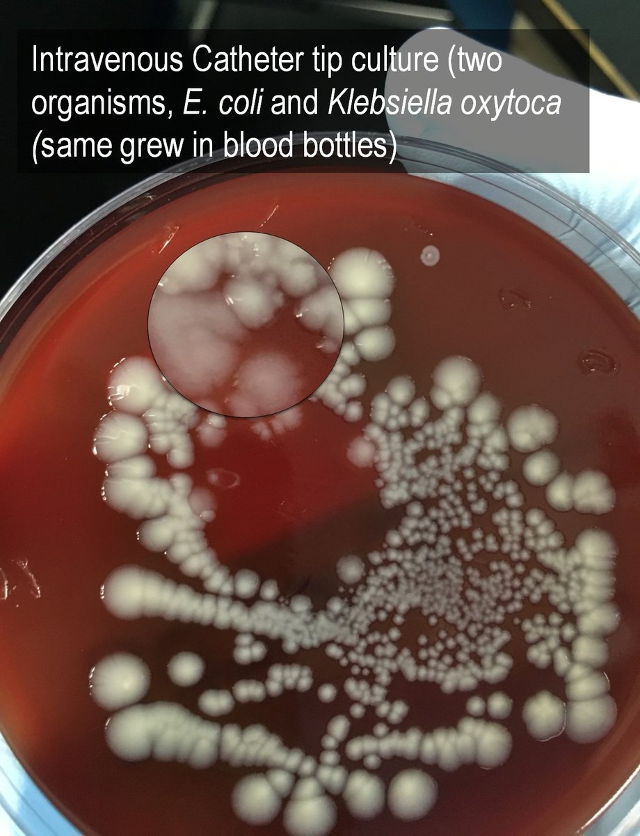 To start, here's doctor  @drswlong who is one of just several great lab leaders from the state of Texas. Here's an intravenous catheter tip that grew not just one but two Gram negative rods: K. oxytoca and E. coli https://twitter.com/drswlong/status/1252337914635264000?s=20