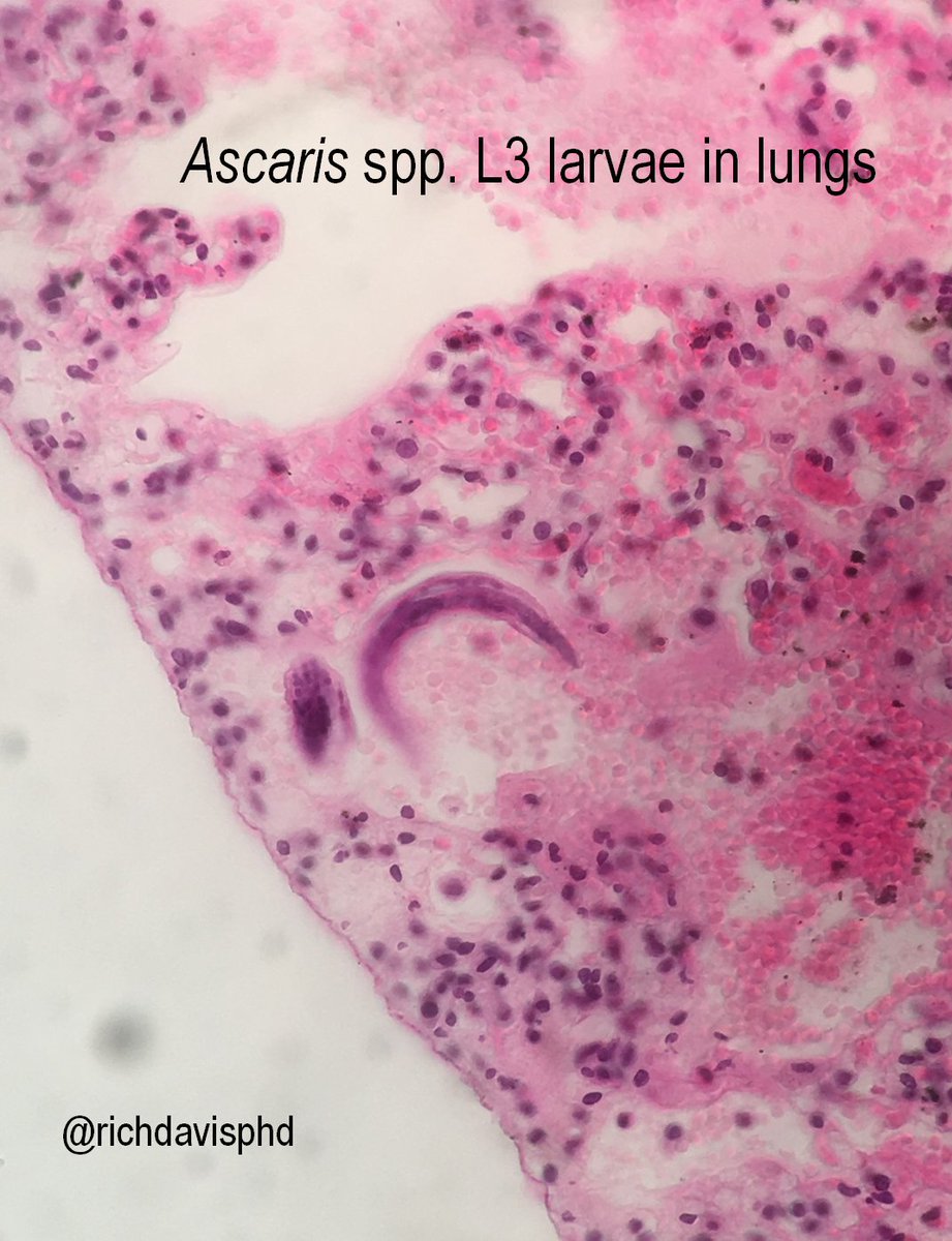 A GREAT article highlighting the role of lab workers in Canada by  @MultanMichael. Thanks!Pathologists like  @Sara_Jiang and MANY others have really optimized social media for education and outreach.Here's an Ascaris larva in a lung biopsy #LabWeek2020 https://twitter.com/MultanMichael/status/1252339187035934720?s=20