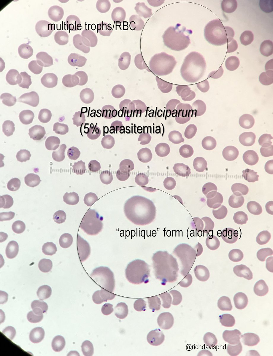A great resource for hematology pictures is  @underthe_scope! #LabWeek2020  #MLPW2020 Here's a blood smear showing some classic Plasmodium falciparum characteristics. https://twitter.com/underthe_scope/status/1252338625833865216?s=20