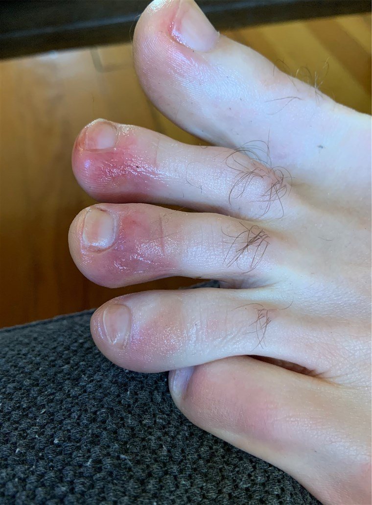 7/ The 2nd doesn't look retiform, but it reminds me of perniosis/chilblains. Pernio is usually seen with cold/damp weather. On histology, there is inflammation/edema, and some reports of a lymphocytic vasculitis.In kids, this can be assoc w/ cold agglutinins or cryos.