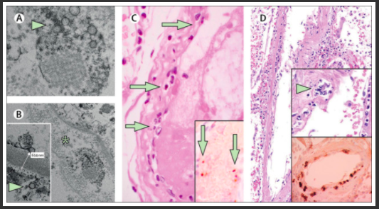 9/I would make a couple other points:We already know that there is some thrombotic process with some cases of  #COVID19. Perhaps  #covidtoes are related to that. This paper found  #SARS_CoV2 infected patients had viral inclusions in endothelial cells: https://www.thelancet.com/journals/lancet/article/PIIS0140-6736(20)30937-5/fulltext