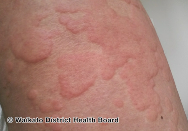 11/ I should point out that there have been a host of other skin eruptions reported with  #COVID. I think many of them are nonspecific and may just be reflections of the immune system dealing with a viral process.  #Covidtoes seem to be much more specific for this.pc:  @dermnetnz