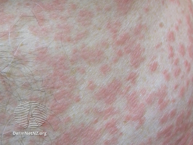 11/ I should point out that there have been a host of other skin eruptions reported with  #COVID. I think many of them are nonspecific and may just be reflections of the immune system dealing with a viral process.  #Covidtoes seem to be much more specific for this.pc:  @dermnetnz