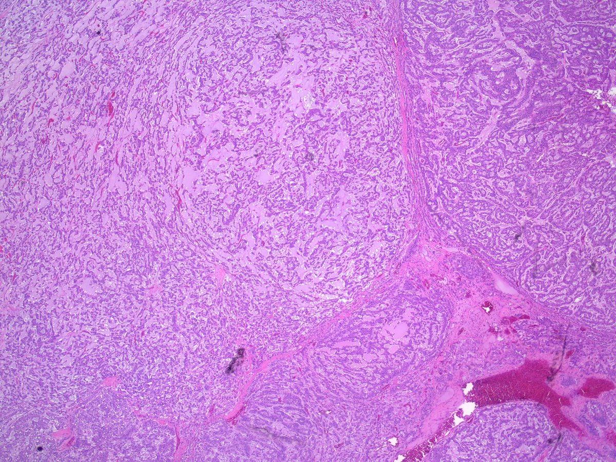 Teclis82's tweet photo. 40 year old female, adrenal mass, 2.2cm.  Clinically a nonfunctioning adrenocortical adenoma.  Resected.
#pathresidents:  Ddx? Benign? Malignant? Primary? Workup?
#GUpath #surgpath #pathology
@Williamson_SR @rovingatuscap @Kiril_T_Can 
1/3 https://t.co/e3WdnWtfbi