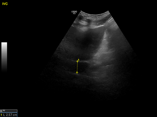 Simple-appearing  #IMPOCUS scenario but important!Thread:1/ Consulted for AKI. Patient: Middle-aged gentleman with significant peripheral edema. Plan: Let's try diureticOh, may be perform  #POCUS -> IVC looks plump, doesn't appear to collapse  = needs diuretic.  #MedEd