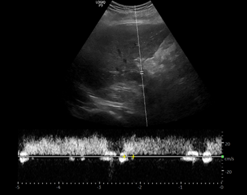 2/ but the renal attending likes to do  #VExUS Let's look at portal vein  #POCUS-> Looks great, doesn't seem to indicate congestion