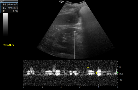 3/ What about the renal vein  #POCUS?Not a great picture due to breathing but seems the waveform is continuous (appears noisy because the gain was increased intentionally) [don't pay attention to RI - its inaccurate]