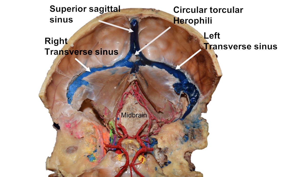 pipoulou_kgb's tweet photo. ⏩#Herophilus réfute les théories d'Aristote sur les fonctions du cerveau et du coeur. On lui doit la description des sinus veineux du crâne dont la réunion à la face endocrânienne de l'écaille occipital s'appelle encore le pressoir d'Hérophile, ou citerne, torcular. ⏩ https://t.co/v2TGdzP3ou