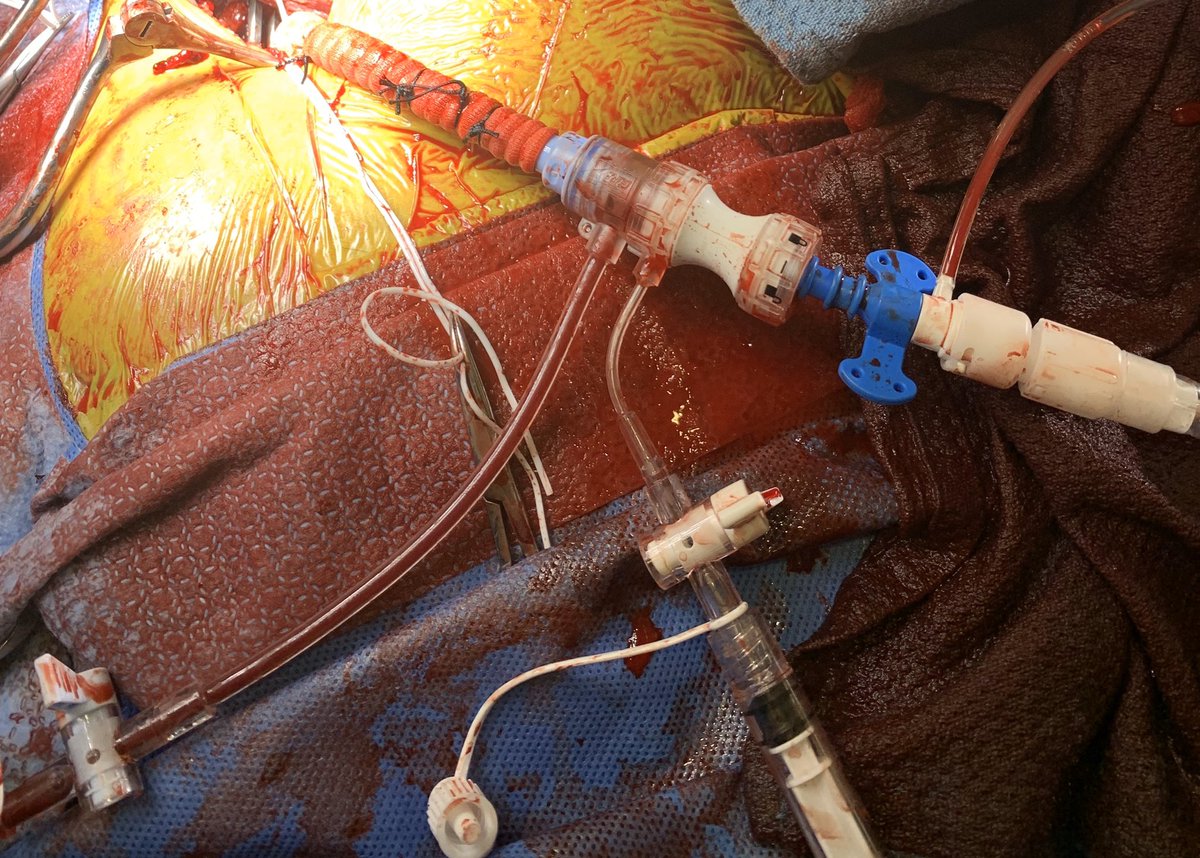 kevinjamescroce's tweet image. Graft is a bit longer than I like but alas....we got it in. @jason_wollmuth @ekgpdx @duanepinto #PCIMasters