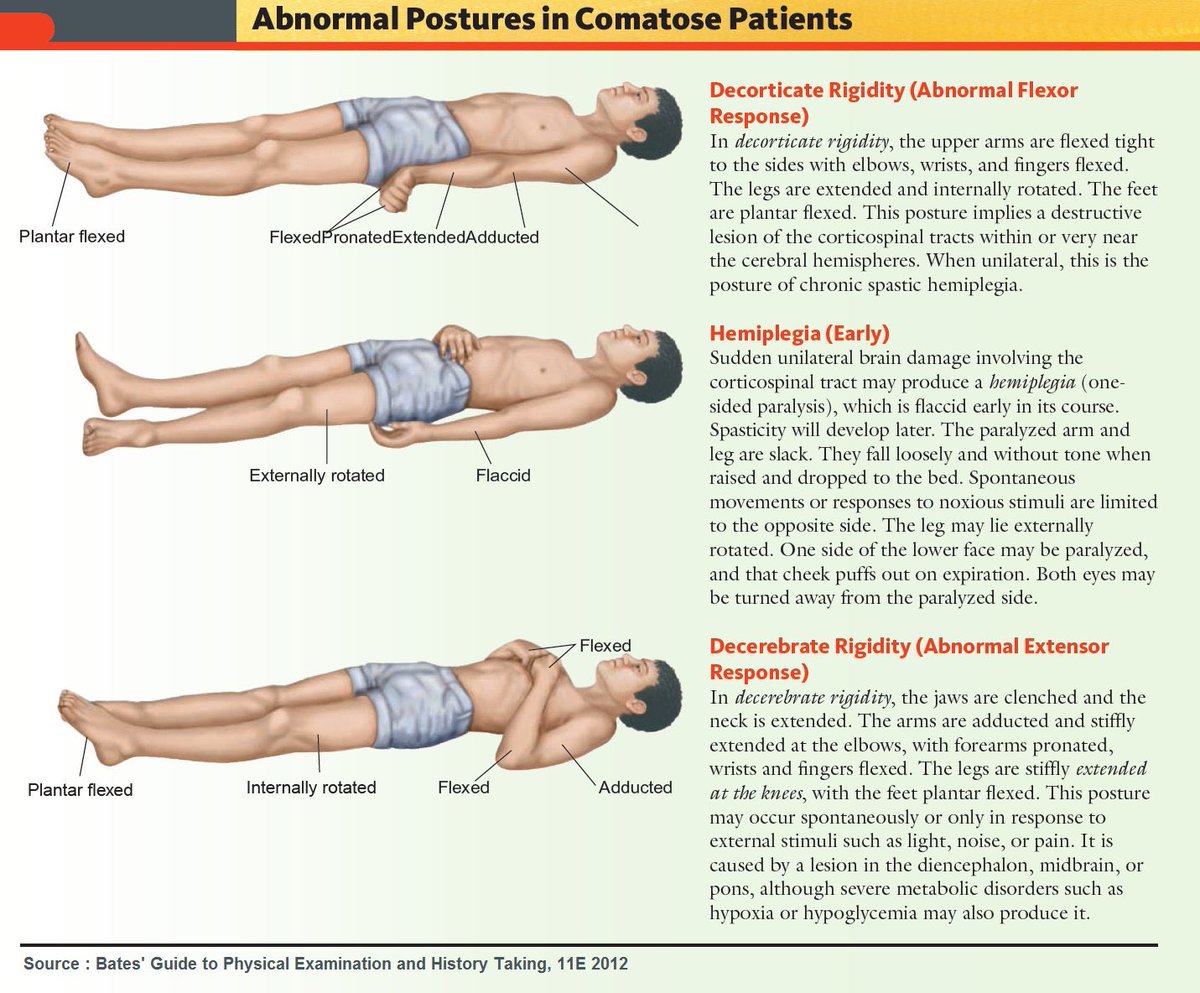 separate pathology from what would have been the original virus, type A. Here are examples of the “fall down one”. Flat, stiff, sometimes convulsed. The posture is normally indicative of neurological damage. The US has type A, and could be the reason we haven’t seen this here, at