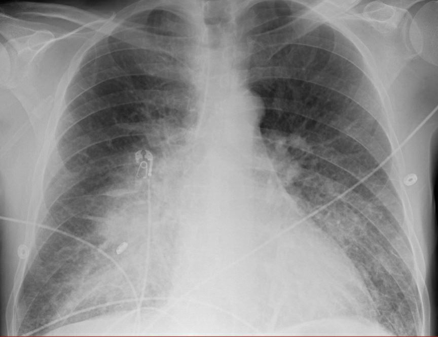 A case in the age of  #COVID19A 50 yo man with no PMH came to ED with confusion & hypoxemia. Admission CXR shown. Possible COVID+ contact.A ProtectingB RR 28 SpO2 92% 60% HFNCC BP 90/65 HR 105, Cap Ref 4 sD A&0 x 4E - T 37.9L CRP 3x ULN, WBC 21 (PMNs) #Tweetorial