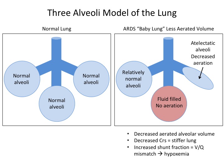 5/ In ARDS, the functional size of the lung is reduced because some of the alveoli are collapsed or filled with non-cardiogenic pulmonary edema. This is called the “baby lung” model. Since there are fewer well-aerated alveoli, the lung is overall stiffer ≈ reduced Crs.