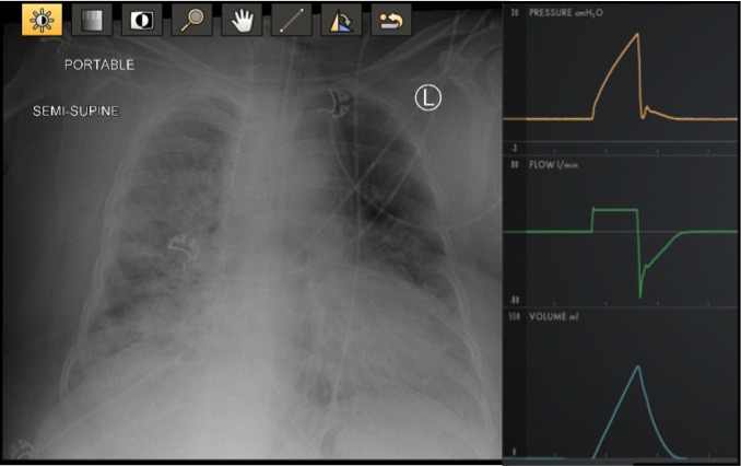 1/20 Tweetorial about Lung Protective Ventilation and Driving Pressure motivated by the complex vent management in  #Covid-19. Enjoy! Note- all in Volume Control @cardionerds  @CPSolvers  @thecurbsiders  @DxRxEdu  @AnnaPodolanczuk  @BBroderickMD  @sanjayvdesai  @sanjum  @DrDaleNeedham