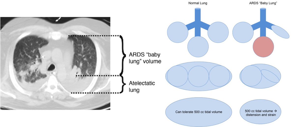 6/ If you deliver the same volume to the “baby lung” as a normal lung → high distending pressures and strain → ventilator-induced lung injury. This is why low Vt ventilation is lung protective. One measure of this is plateau pressure, and we think levels > 30 are harmful.