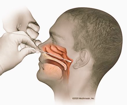 Barusan hbs diswab lg huhuhuIni tuh slh satu alasan knp kelen jgn smp kena corona ya gaes, swab tuh ga nyaman bgt. Bayangin aja cotton buds raksasa dicolok ke dlm hidung sampe mentok ke belakang.Yg dicolok 2 lubang hidung sm tenggorokkan kelen (ini plg nyiksa, kyk mo muntah)