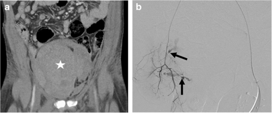 cvirendo's tweet photo. Conventional #angiography findings in hemodynamically unstable patients with acute abdominal hemorrhage and a negative CT bleeding study | https://t.co/RTOdJGCVjs  @UofGlasgow @svuh #irad #FOAMed #openaccess #interventionalradiology https://t.co/1M3qKXwmU9