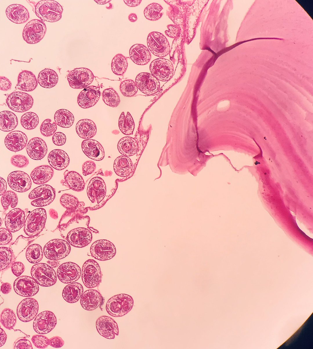 Very nice case 🤩 spot diagnosis🥳🥳🥳 lung cyst 🤞🏻🤞🏻🤞🏻<a href="/pembeoltulu/">Pembe Oltulu, MD</a> <a href="/dokemal/">Kemal Kösemehmetoğlu</a> <a href="/JMGardnerMD/">Jerad Gardner, MD</a> <a href="/forthejon/">Jonhan Ho</a> <a href="/barkanga/">Güliz Akdaş Barkan</a> <a href="/Bakirkem/">kemal bakir</a> <a href="/betulunalmd/">Betül Ünal</a>