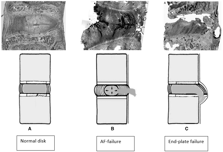 In this thread, I want to propose that the anatomy of failure is the end-plate (EP), rather than the annulus fibrosus (AF). Hopefully, this might add some clinical value and a proposed explanation as to why some patients do worse in the long-term following a disc herniation.