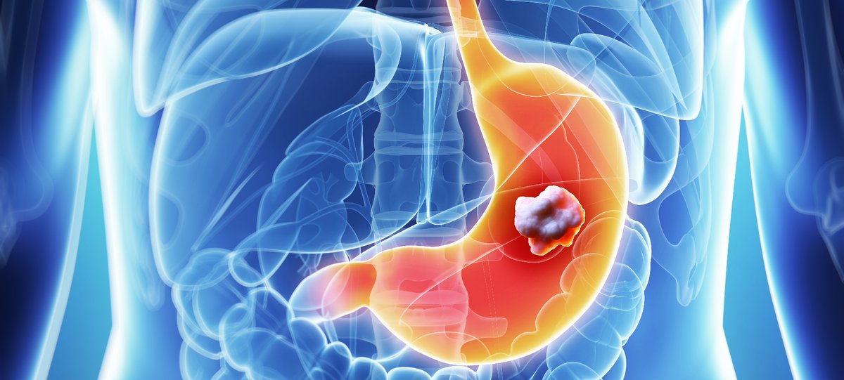 Online Training 29.04.2020, 18:00 (CEST): 
Metastatic Gastric Cancer

Speakers:
Prof. Dr. med. Florian Lordick, Leipzig
Prof. Dr. med. Gerald Prager, Vienna
Prof. Dr. med. Aziz Zaanan, Paris
Prof. Dr. med. Markus Maximilian Borner, Switzerland

Registration: info@beupdated.ch