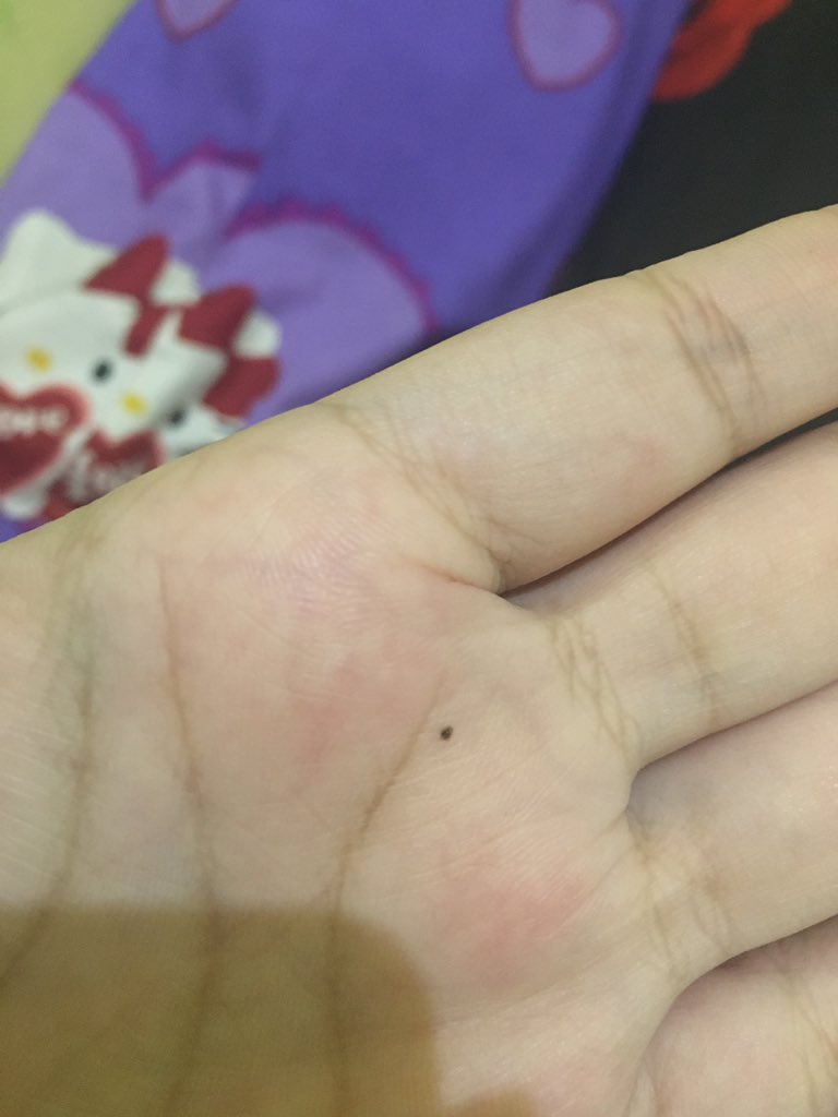 Ajjah On Twitter Selama Uwe Hidup 18 Tahun Kaga Pernah Punya Tanda Lahir Di Telapak Tangan Kiri Anjay Kirain Luka Kok Kaga Bekas Aneh Anjay Https T Co Xvoglgzm6m