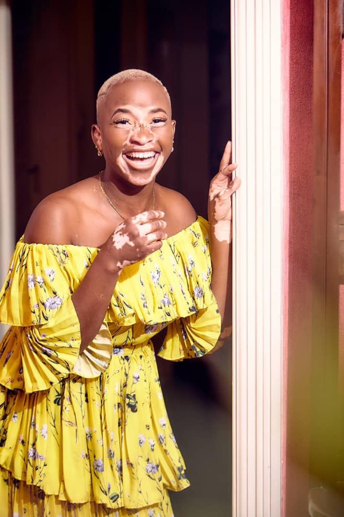 MugabeRumbidzai's tweet photo. I have mischievous dimples that come out when they want to. Well then gotcha. 😆 📷: @trevorgupo MUA: @norah_m__ #vitiligorocks #yummymummy #smile😊 #picoftheday #thesegenesaintnojoke #choconilla #blaquexellence https://t.co/bKXIutwQyi