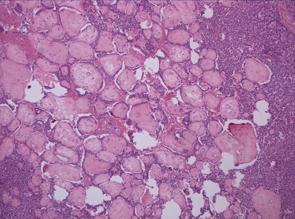 RunjanChetty's tweet photo. 90% of this pancreatic NET was composed of these areas.  They look like chorionic villi!  Very minor solid component: top right corner of image 1.
Never seen it since! Anyone else seen this pattern? https://t.co/0dsgB4doao