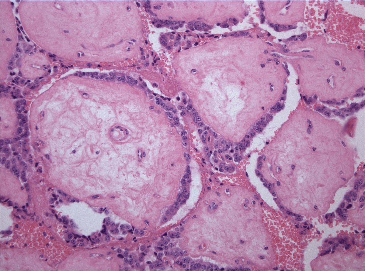 RunjanChetty's tweet photo. 90% of this pancreatic NET was composed of these areas.  They look like chorionic villi!  Very minor solid component: top right corner of image 1.
Never seen it since! Anyone else seen this pattern? https://t.co/0dsgB4doao