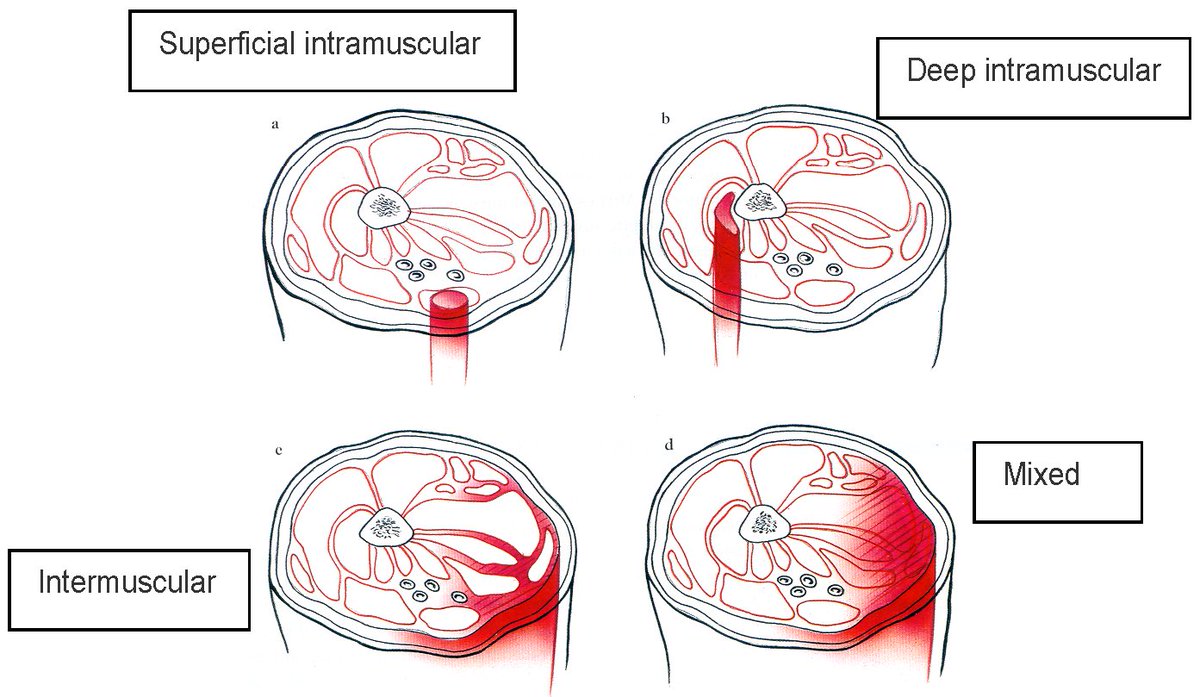 (3/7).A. Intramuscular: Bleeding w/in muscle. Becomes trapped w/in muscle sheath. Results in restricted motion/flexibility & is typically more painful. Tends to be longer recovery.B. intermuscular: Bleeding around the muscle & can escape into surrounding tissue. Faster recovery