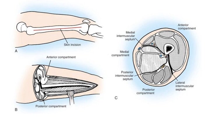(5/7). Compartment Syndrome (continued):* Most commonly affects lower leg; Can affect thigh* Also seen in upper extremity, foot, hand, glutes, abdomen.* Treatment is emergent surgery (fasciotomy) to decompress compartment & relieve pressure.