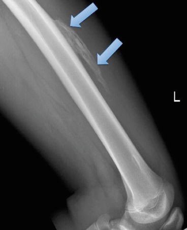 (6/7). Myositis Ossificans:* Formation of bone-like tissue in the muscle after blunt trauma &/or repeated injury.* Can occur in up to 18-20% of quad contusions; usually develop w/in 2-4 wks after trauma.* Can be painful & limit motion.(Continued)