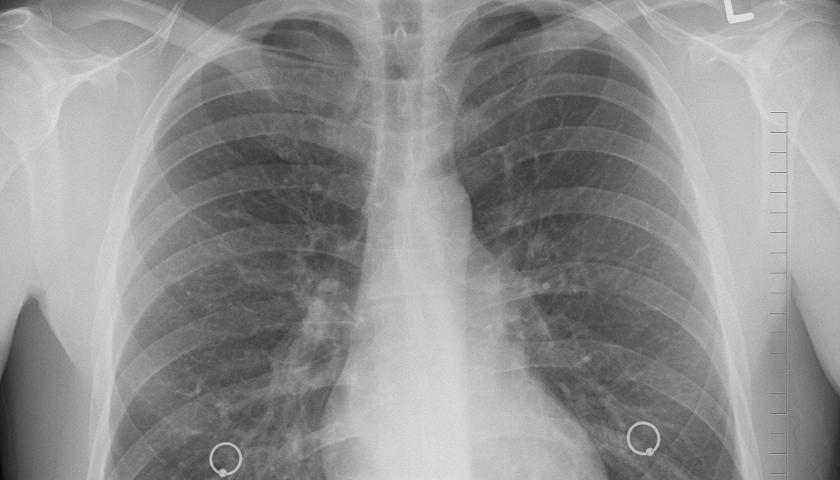 Not good:

After examining a small group of patients who recovered from Covid 6 weeks ago after only mild symptoms, the doctors reported that "The damage to the lungs is irreversible"

rainews.it/tgr/tagesschau…