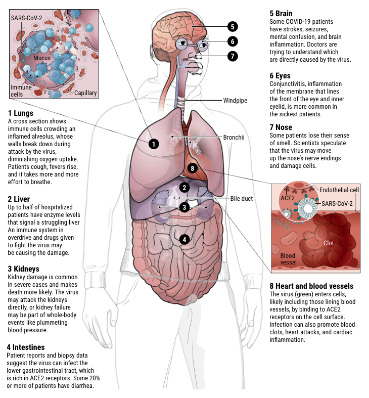 fritsfranssen's tweet image. The invader&apos;s impact... SARS-CoV-2 lands in the lungs and can do deep damage there. But the virus, or the body’s response to it, can injure many other organs. #COVID19 sciencemag.org/news/2020/04/h…