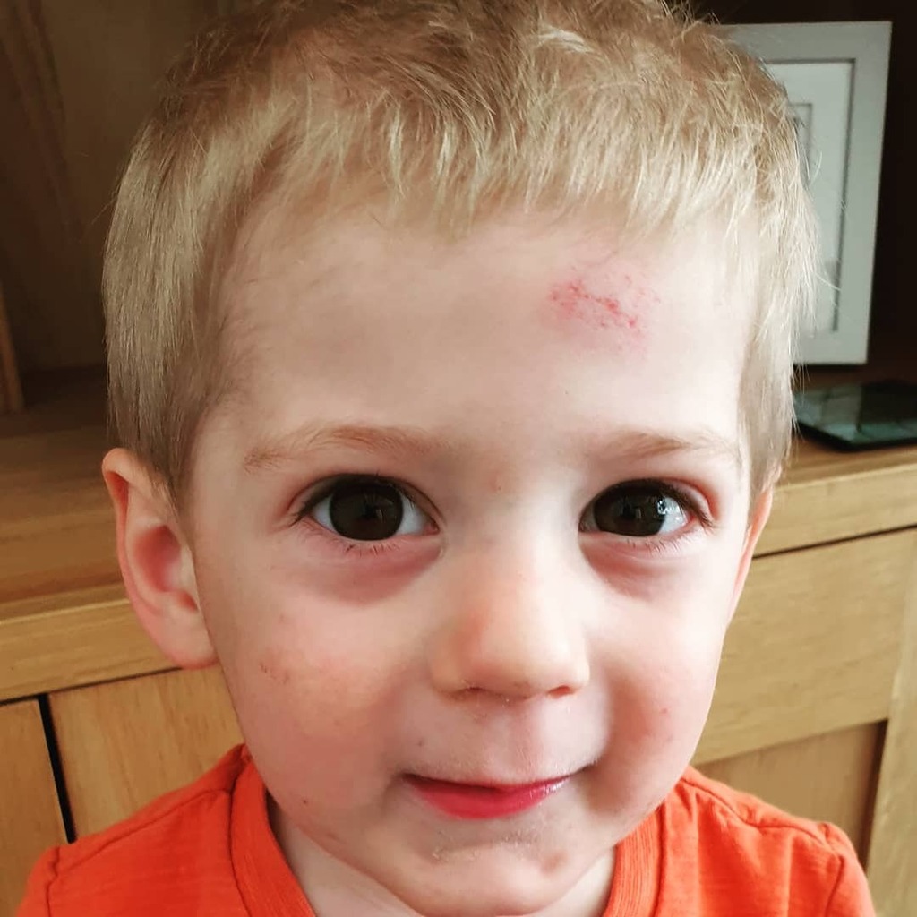 mandymoo2584's tweet photo. My mum said that when I was younger I was forever in the wars,  falling over,  and generally scaring the life out of her with my many bumps and scrapes....
She also said karma would happen and it has in the form of Matthew 🤕🤕🤕
#Matthewjoseph #myboy #feral #littlefierceone #l… https://t.co/dLOWx49nvL