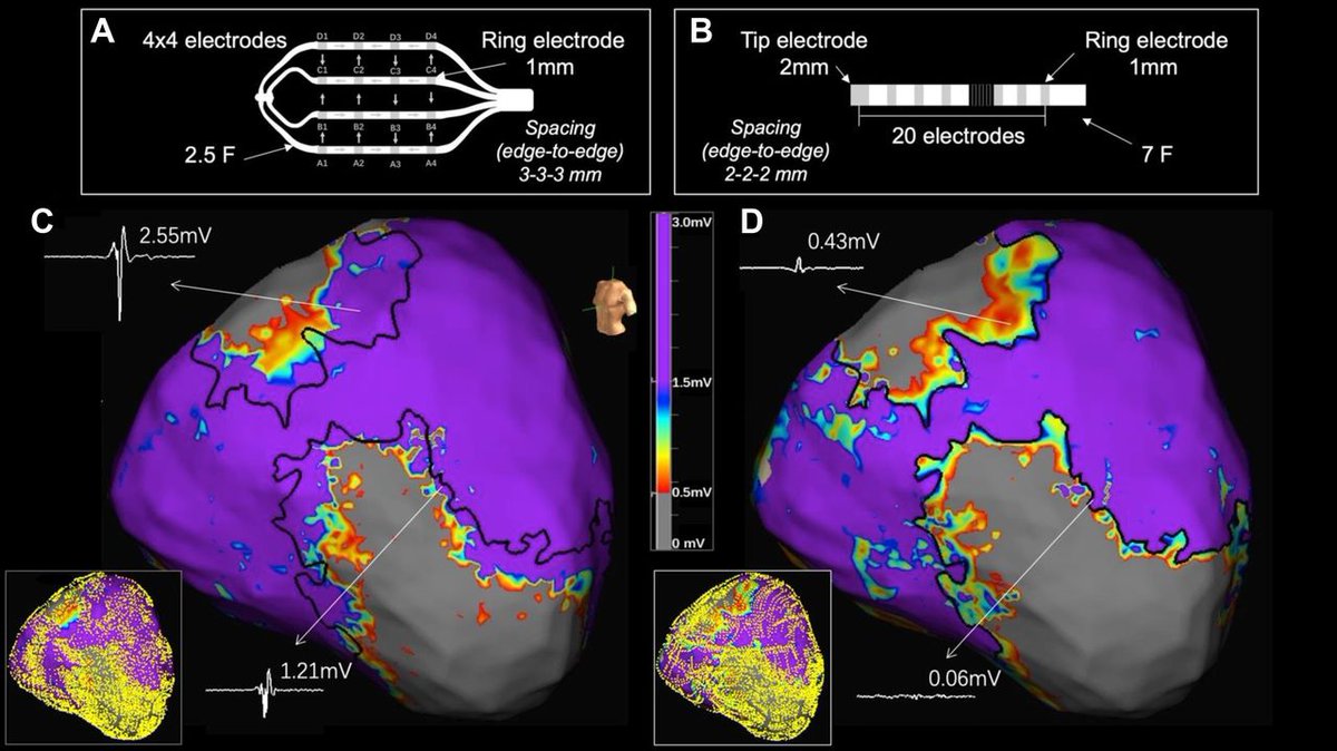 .<a href="/DrRoderickTung/">Roderick Tung</a> et al. showed 96% colocalized w/ critical ventricular tachycardia isthmus w/ sinus rhythm decelation zone, where HDGrid catheter mapped a significantly smaller low voltage area compared to linear catheter. bit.ly/3ckHQmf #AblateVT #JACCCEP <a href="/AbbottCardio/">Abbott Cardiovascular</a>