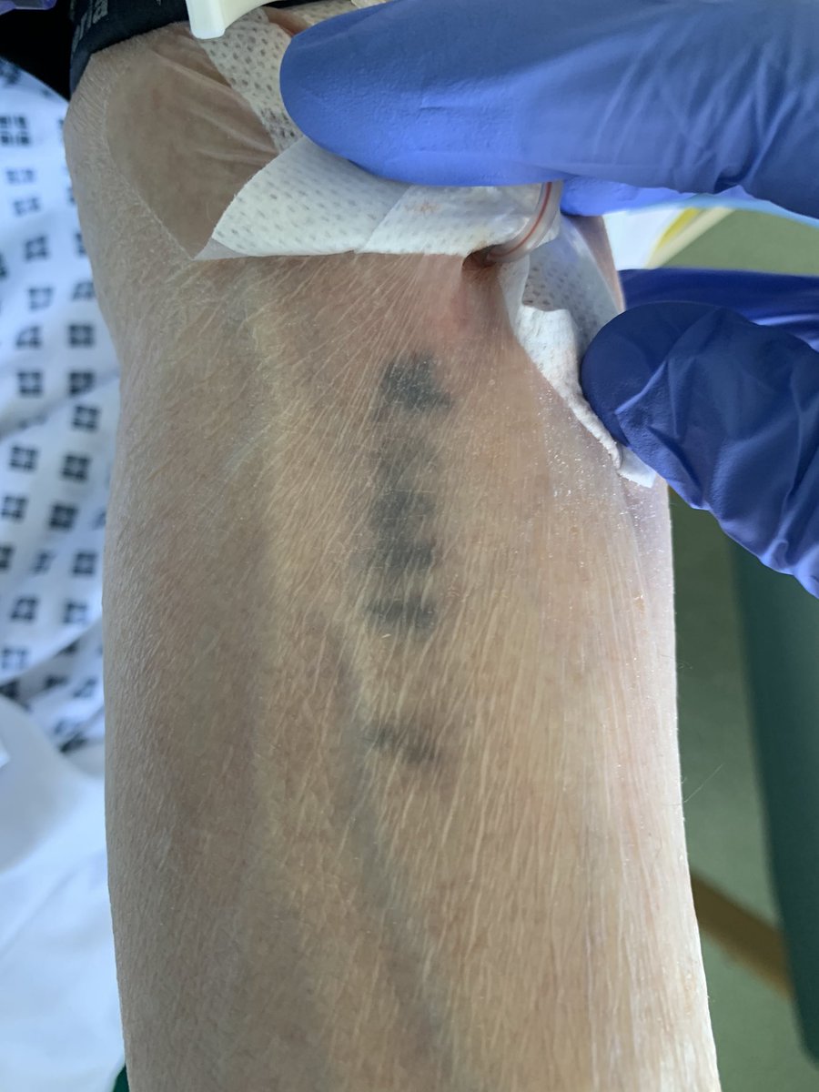 Elliot Smith (@smithelliotjs) on Twitter photo Moved & privileged to treat this 85 yo Auschwitz survivor on #HolocaustMemorialDay. Thx <a href="/RoyalFreeHAC/">Royal Free Heart Attack Centre</a> for state of the art heart attack treatment. He asked us to share his story & tattoo #NeverForget <a href="/YellowCandleUK/">Yellow Candle</a> <a href="/oliverguttmann/">Oliver Guttmann</a> <a href="/yomhashoahuk/">Yom HaShoah UK</a> <a href="/sundeepkalra/">Sundeep Singh Kalra</a> <a href="/JeremyCraneMD/">Jeremy Crane</a> Moved & privileged to treat this 85 yo Auschwitz survivor on #HolocaustMemorialDay. Thx <a href="/RoyalFreeHAC/">Royal Free Heart Attack Centre</a> for state of the art heart attack treatment. He asked us to share his story & tattoo #NeverForget <a href="/YellowCandleUK/">Yellow Candle</a> <a href="/oliverguttmann/">Oliver Guttmann</a> <a href="/yomhashoahuk/">Yom HaShoah UK</a> <a href="/sundeepkalra/">Sundeep Singh Kalra</a> <a href="/JeremyCraneMD/">Jeremy Crane</a>