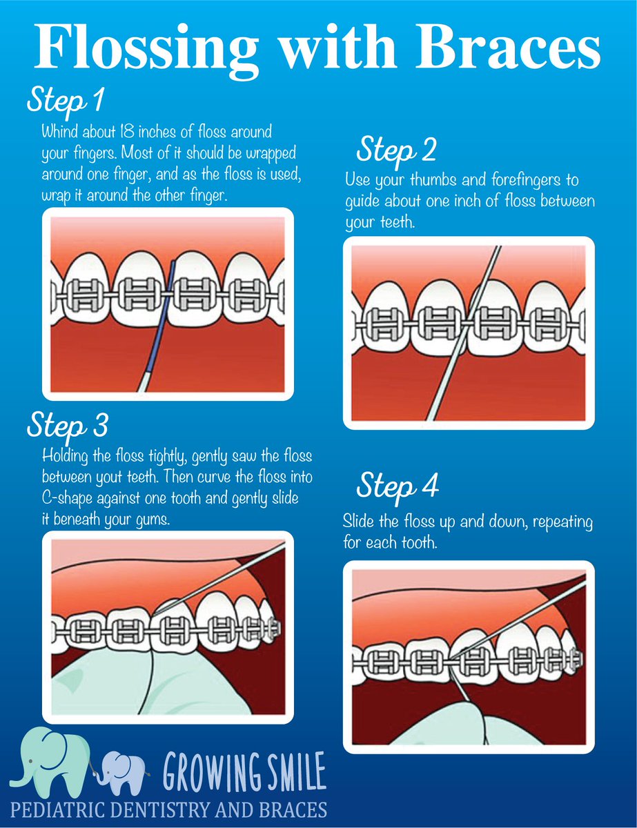 Show off your new braces! Now that you have them, how do you take care of them?
Flossing with braces is tricky, you can get the hang of it with practice if you follow these steps:

#growingsmile #peabodypediatricdentist #lifewithbraces #braces
#orthodontist