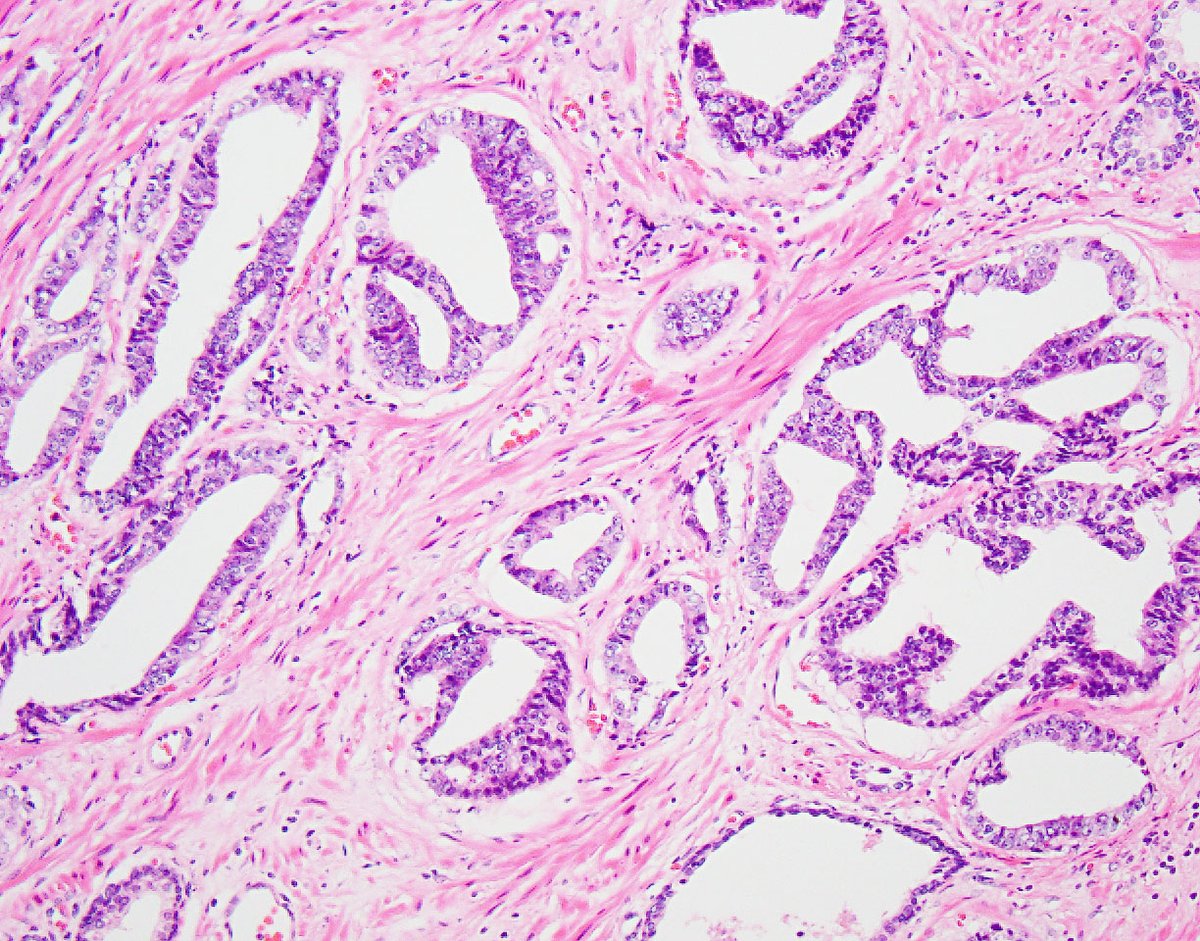 4/ later work by Drs. Tavora & Epstein expanded this spectrum & introduced the term "High-grade PIN-like Ductal Adenocarcinoma of the Prostate" due to the shared feature of nuclear (pseudo)stratification:  https://pubmed.ncbi.nlm.nih.gov/18496142/   #prostatecancer  #gupath