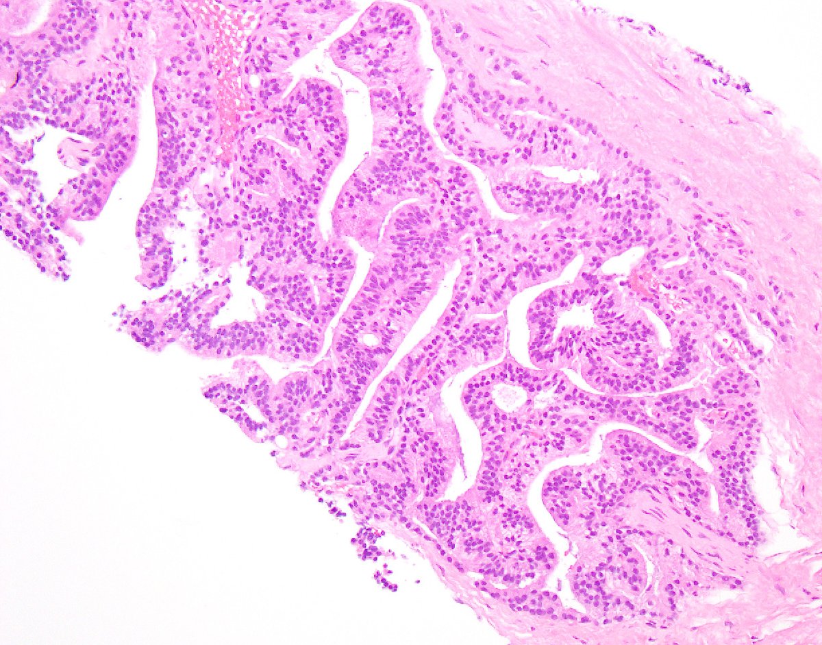 5/ while they reported "PIN-like (ductal)" features are typically associated w/GS 3+3=6 - incorporation of the term"ductal" understandably raises clinical concerns, as majority of “ductal”  #prostatecancer (as seen in pics) is assoc. w/aggressive behavior (~ to GS 4+4=8)  #gupath