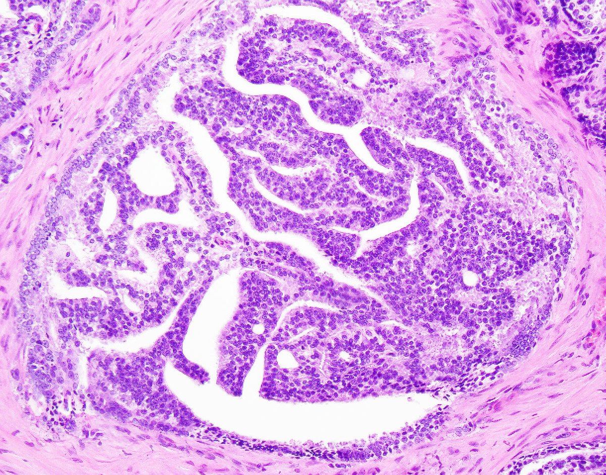 5/ while they reported "PIN-like (ductal)" features are typically associated w/GS 3+3=6 - incorporation of the term"ductal" understandably raises clinical concerns, as majority of “ductal”  #prostatecancer (as seen in pics) is assoc. w/aggressive behavior (~ to GS 4+4=8)  #gupath