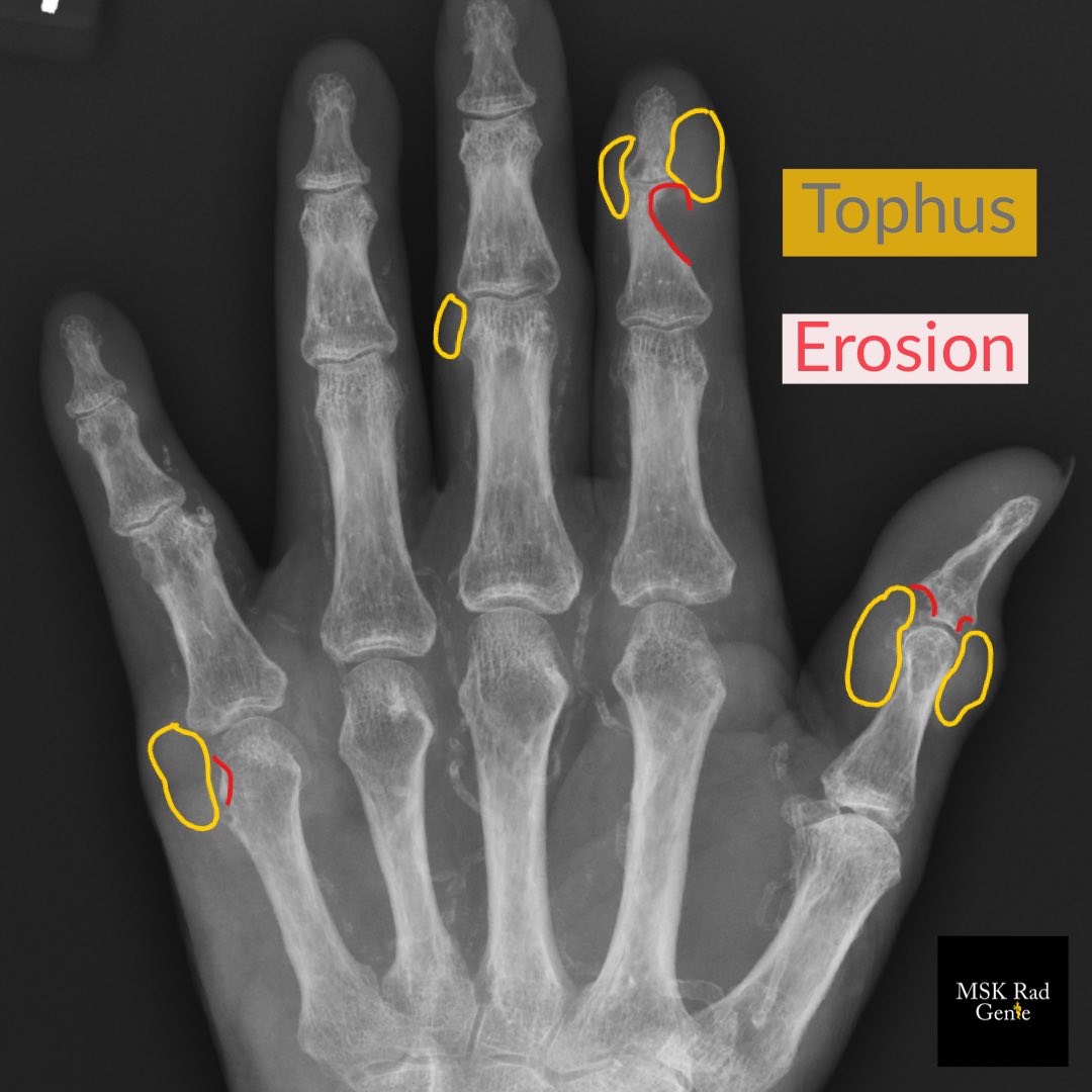 Tophus Xray