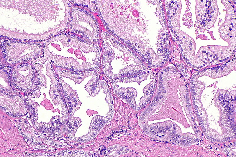 7/ using that distinction may also help distinguish “PIN-like (ductal)” from pseudohyperplastic  #prostatecancer - which also has dilated glands and papillary infoldings, yet is typically lined by cuboidal or low simple columnar epithelium typical of acinar carcinoma  #gupath