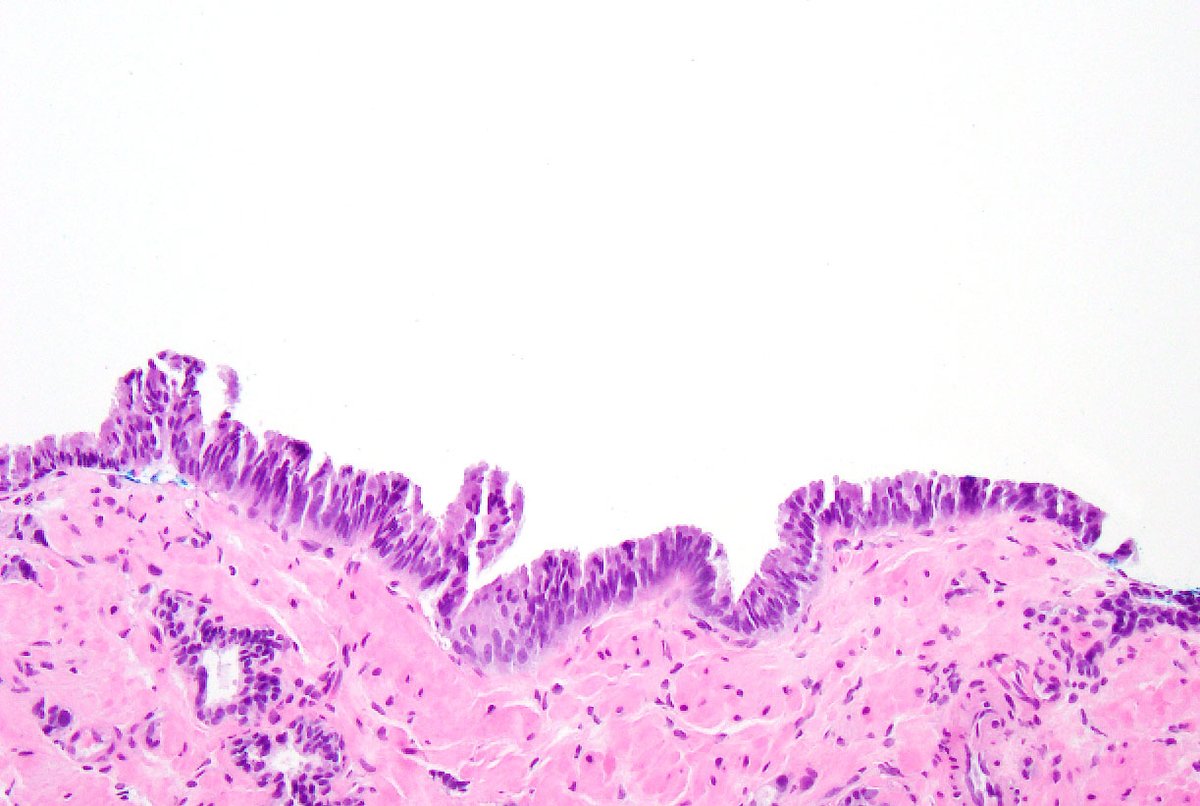 6/ for some, that's sufficient to NOT use "PIN-like ductal" - HOWEVER, if oneat definitions of  #prostatecancer : “ductal”=lined by (pseudo)stratified columnar vs. “acinar”=lined by cuboidal/low simple columnar epithelium, then ‘PIN-like ductal’ may seem reasonable  #gupath