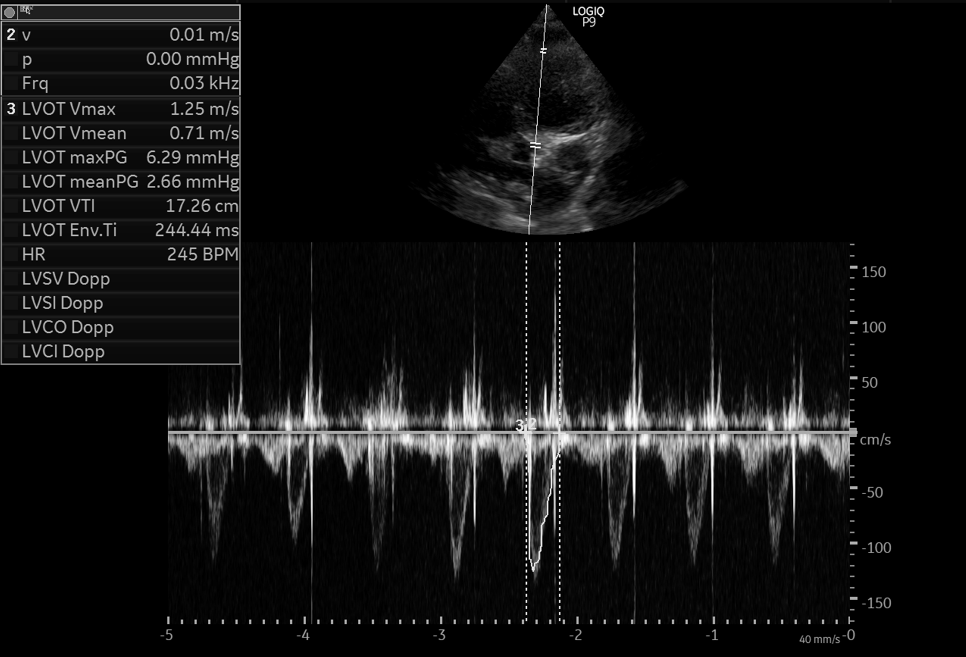 VTI (my clips have not migrated yet...LV function depressed and appears dilated on apical 4C)