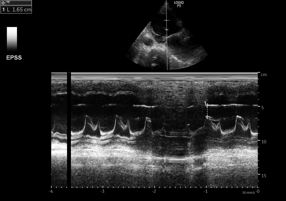 Interesting  #VExUS  #POCUS case. Awaiting input from  @ThinkingCC  @ArgaizR & other sonophilesThread/Middle aged pt with heart failure EF<30% with worsening renal function, low urine output. 1st Image - EPSS: increased as expected (likely some degree of error; anatomic M-mode NA)