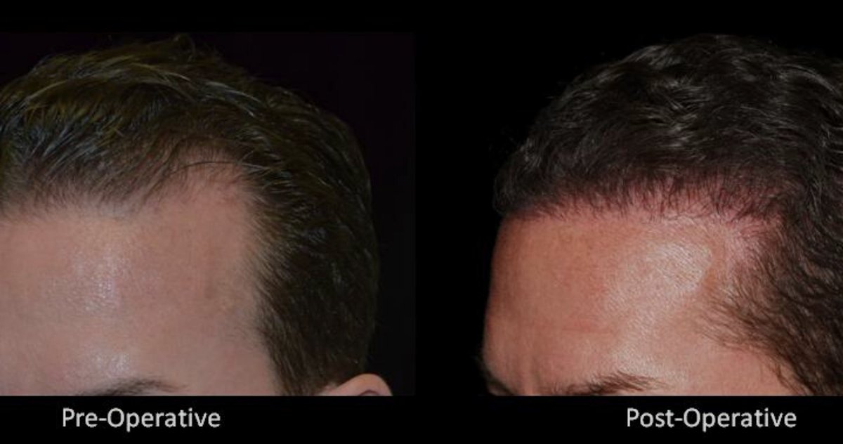 #throwback. 

Dennis and Joe are looking forward to seeing you at your future ARTAS procedure ✨ 

You can't find results like these from just anywhere.