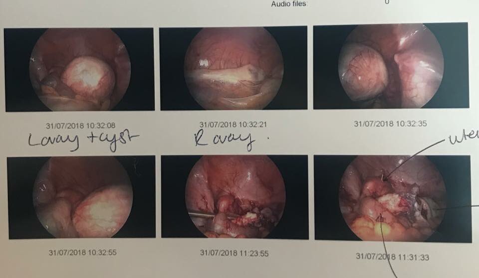 ShaniceMullan's tweet photo. I would love help towards my IVF. I was born without my right tube and my right ovary did not form its stuck to my appendix.Only found out 2 year ago. Endometriosis has destroyed what I do have.I may never have children and it’s killing me 💔 @JeffreeStar #JeffreeStarApproved https://t.co/zOLEWlaJ8K